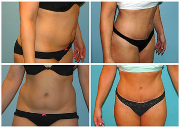 Abdominoplasty Tummy Tuck NJ Before After