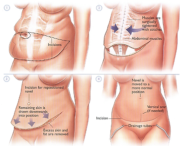 nj panulectomy