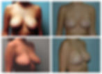MASTOPEXY