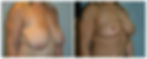 Breast Lift (Mastopexy)