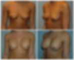 BREAST AUGMENTATION