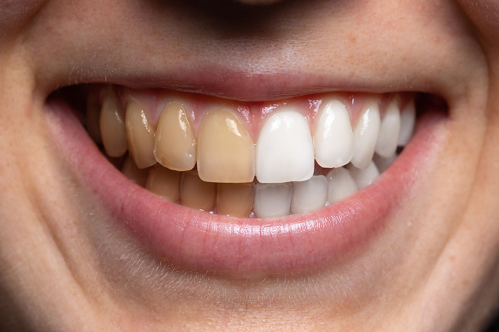 Close-up of a smile showing two rows of teeth; left side is yellowed, right side is white. Skin is light-toned, lips are pink, smooth texture.