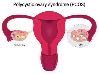 PCOS Case Study: Weight Loss and Improved Menstrual Cycle with TCM