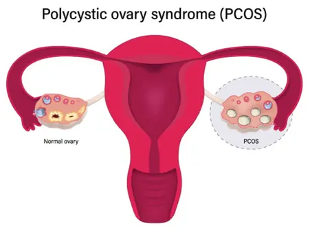 PCOS Case Study: Weight Loss and Improved Menstrual Cycle with TCM