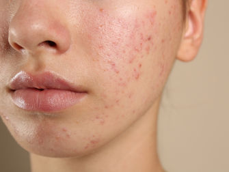 Acne? No Problem! Try These TCM Natural Remedies for Acne