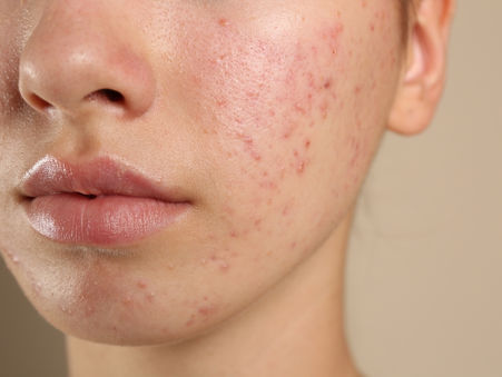 Acne? No Problem! Try These TCM Natural Remedies for Acne