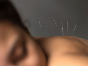 Success Story: Acupuncture and Craniosacral Treats Patient With Menstrual Disruptions