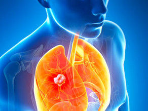 Addressing Respiratory Challenges: How Lung Cancer Hospice Care Provides Relief