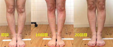 O脚変化写真.jpg