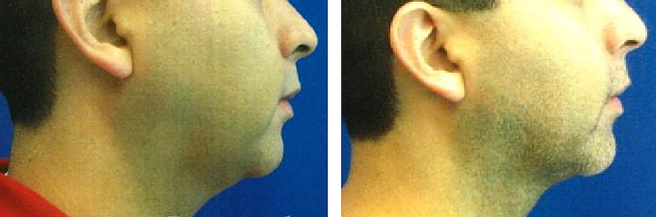 Before and after ReLift Viora image