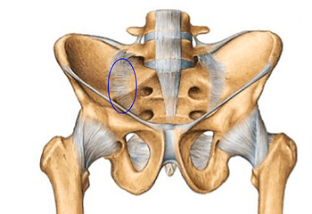 Dor na articulação Sacro-Ilíaca