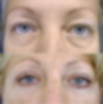 blefaroplastika_1