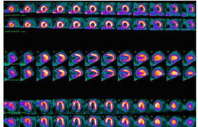 Nuclear_medicine_myocardial_perfusion_sc