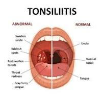 Homeopathy For Tonsillitis