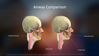 Airway Comparison copy.jpeg
