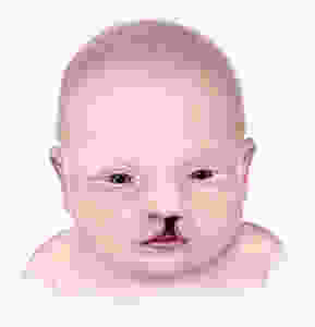 baby-with-cleft-lip
