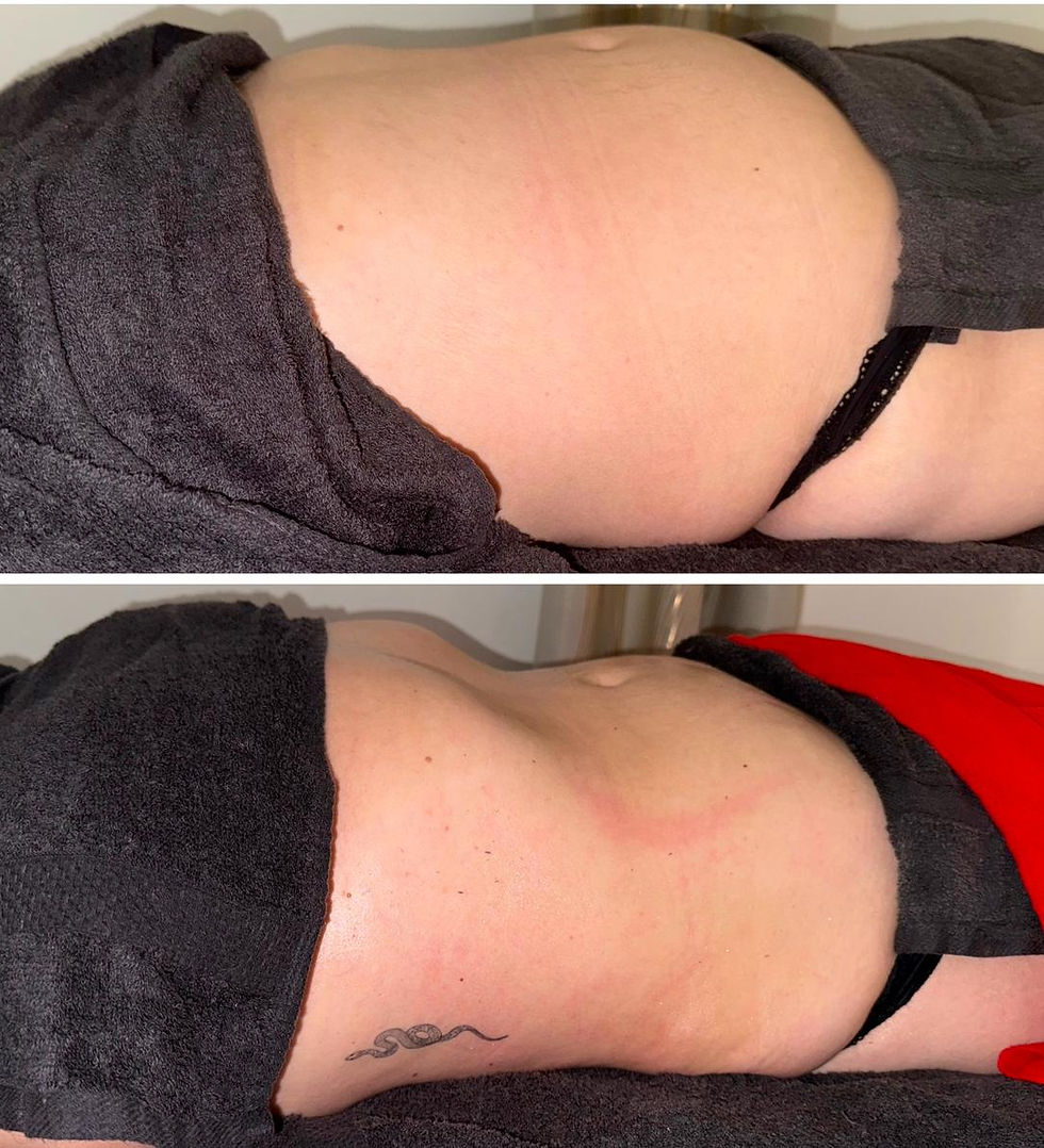 Exemple d'avant – après avec la technique de Drainage Lympathique by Roxane P.