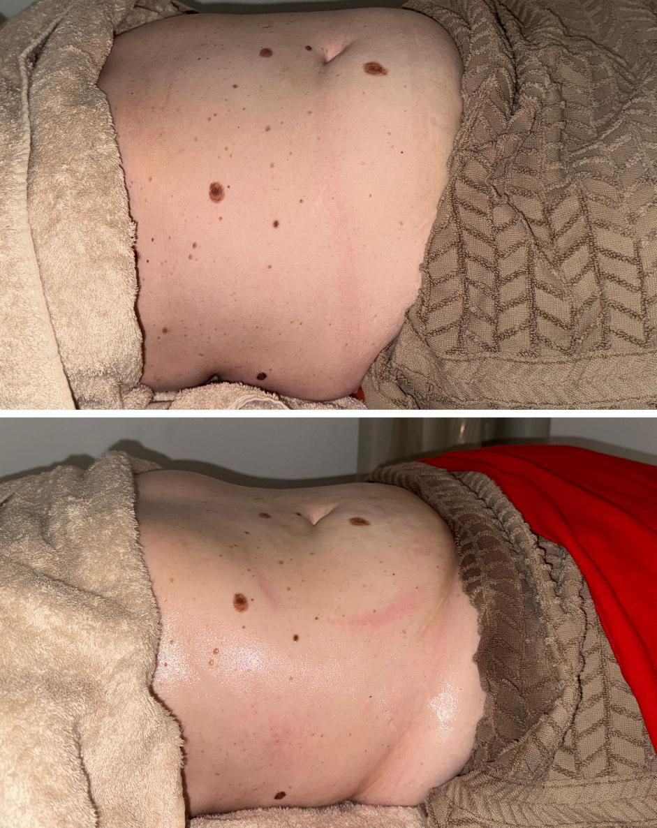 Exemple d'avant – après avec la technique de Drainage Lympathique by Roxane P.