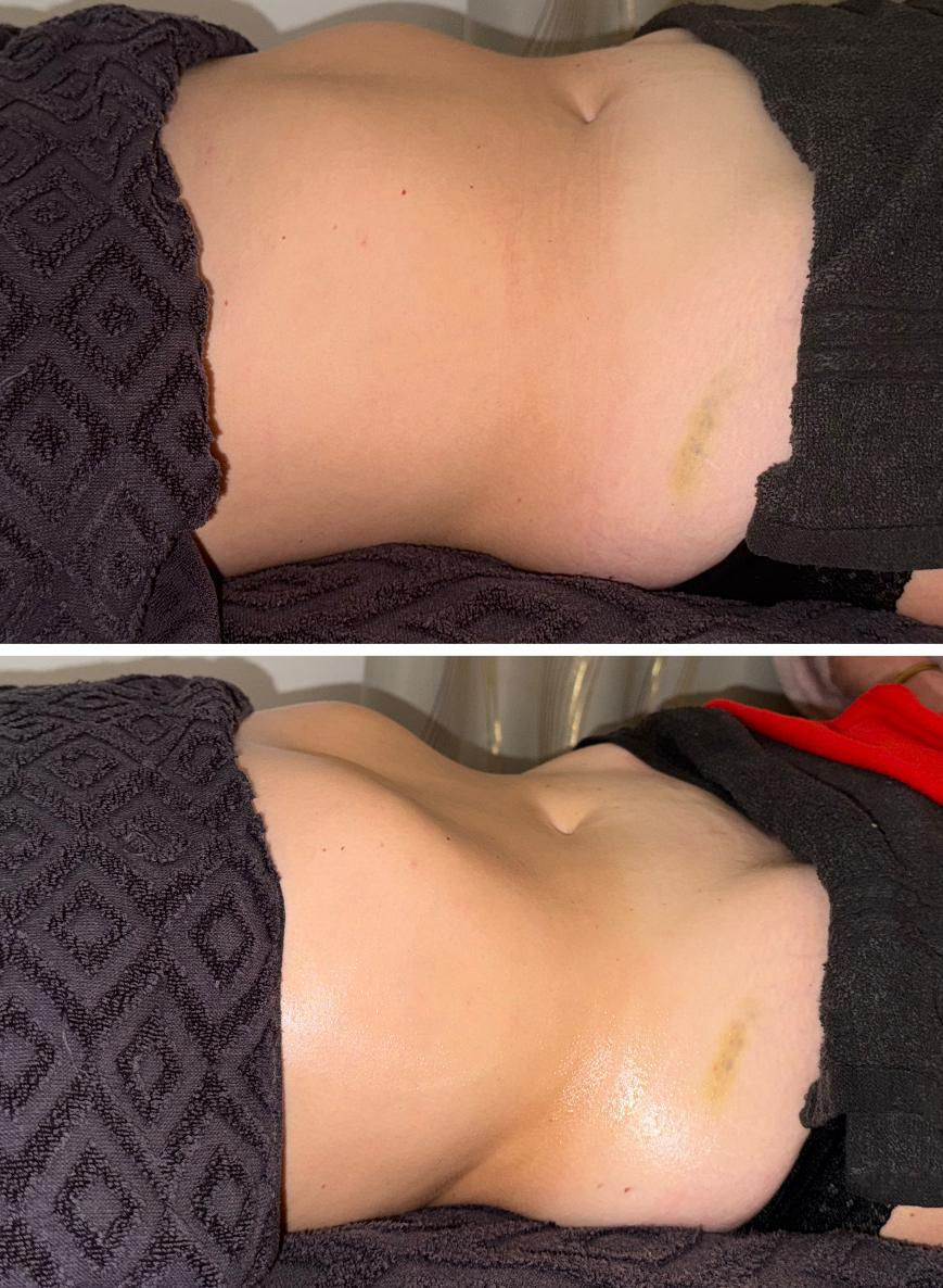 Exemple d'avant – après avec la technique de Drainage Lympathique by Roxane P.