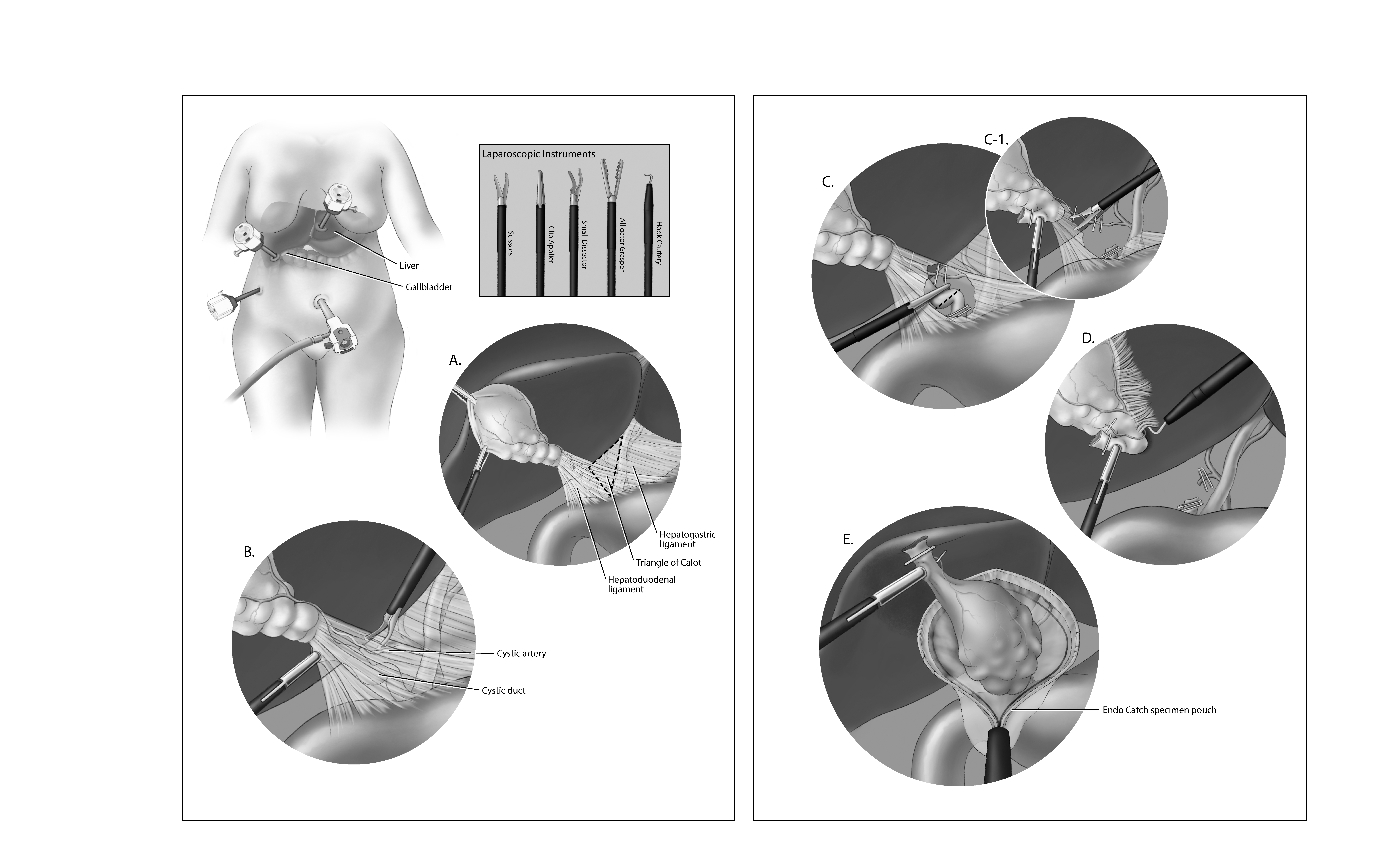 Gallbladder Removal Surgery