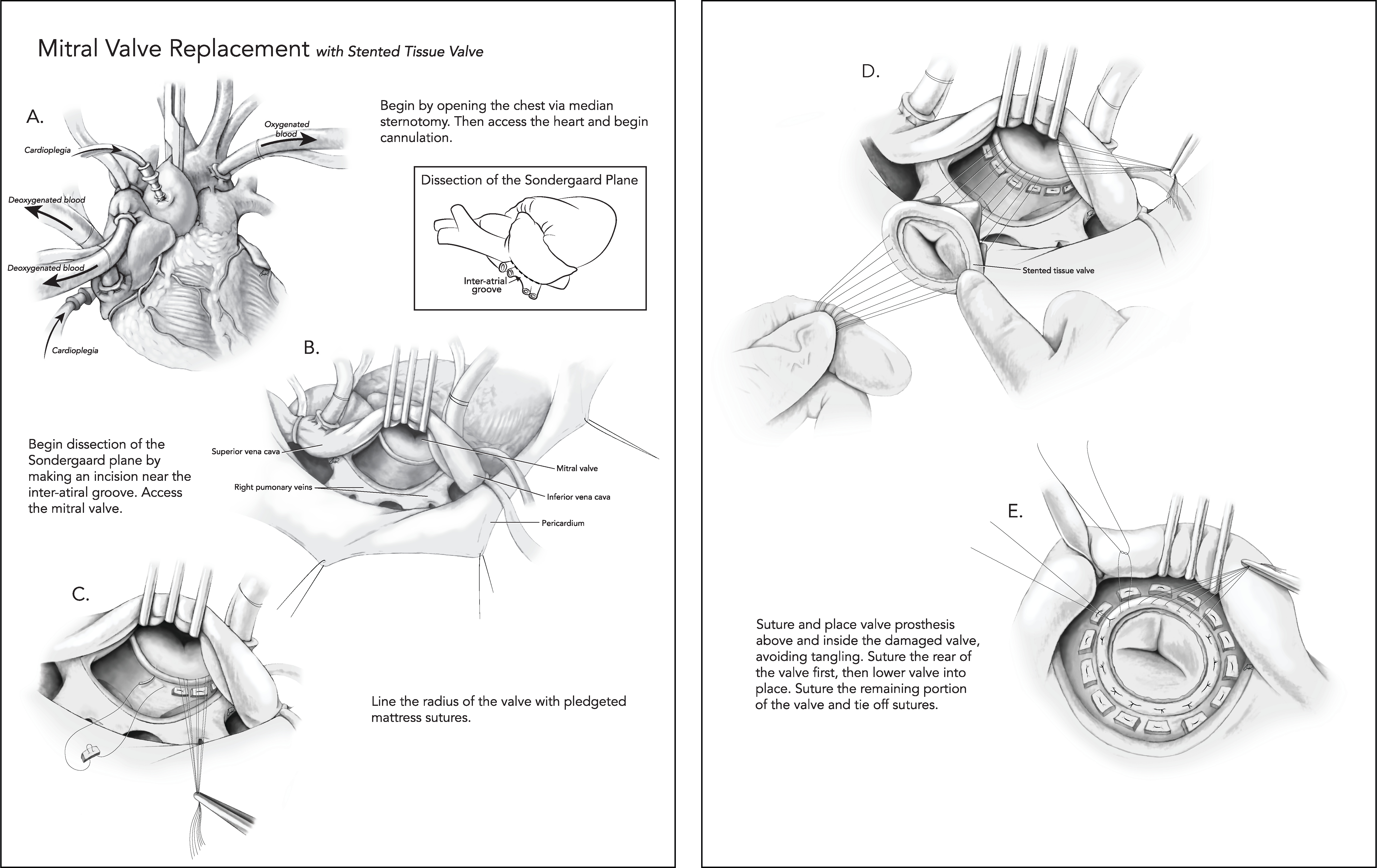 Mitral Valve Replacement Surgery