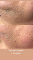 Electrolysis Progress Before and After 3 1hr Treatments