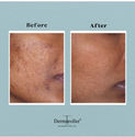 Microneedling Before and After