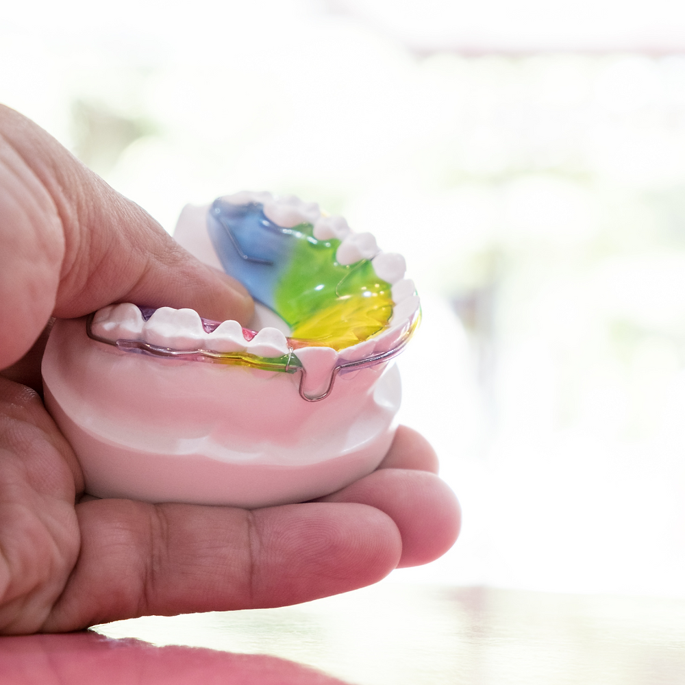 Unlocking Smiles: The Marvels of Functional Appliances in Dental Care