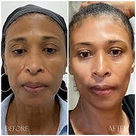 Anti aging before & after 1.jpg