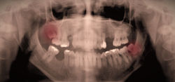 Dentes do Ciso