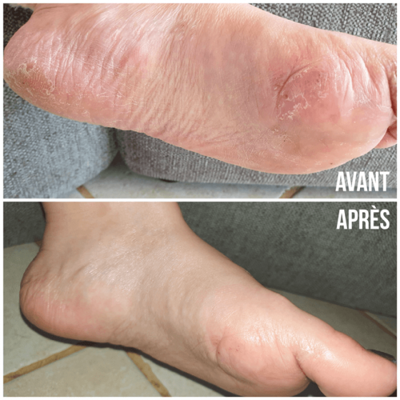 soin-des-pieds-cure-10-jours (3)