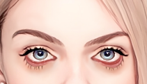 Lower Eyelid Ectropion eyelid laxity