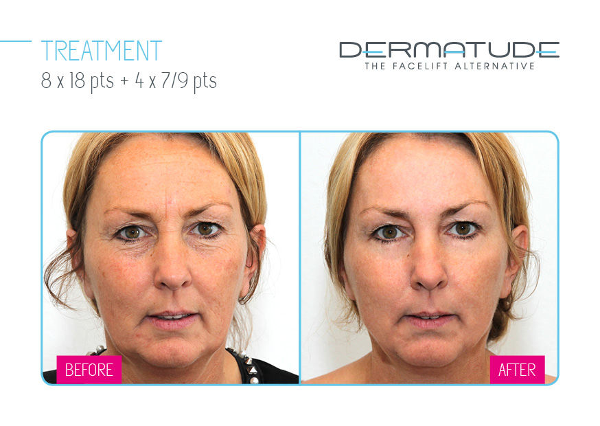 Dermatude Meta Therapy San Diego - Facelift Alternative