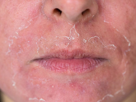 Chemical Peels
