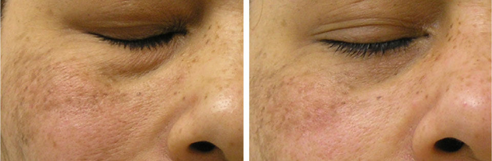 skin-refinement-BA