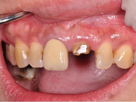 假牙科專科案例分享：專科協同治療，重現自然笑容