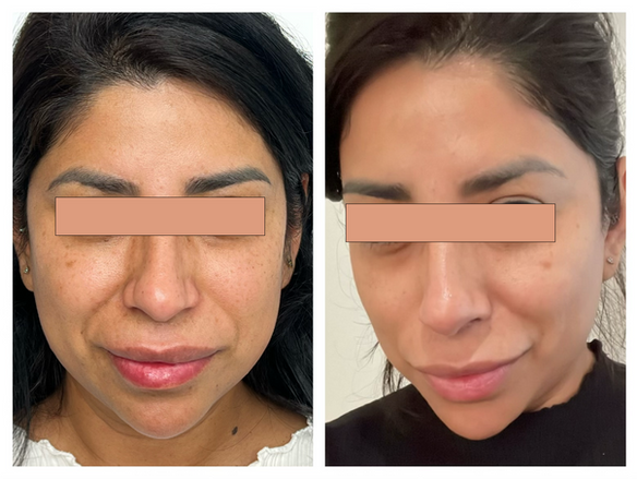 Microneedling gezicht, voor en na