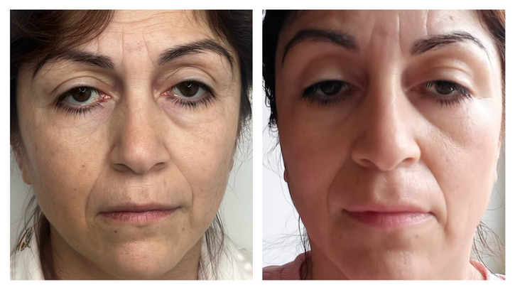 Microneedling gezicht, voor en na