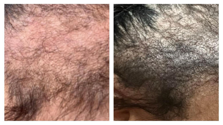 Microneedling haar, vrouw, alopecia voor en na