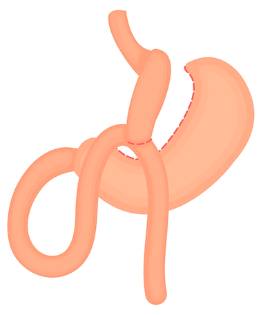 mini-bypass.png