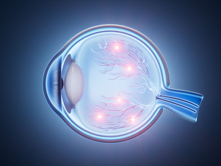 Glaucoma: síntomas, causas y tratamiento para prevenir la pérdida de visión