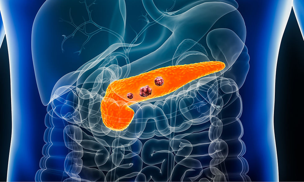 Cáncer de páncreas: síntomas, detección oportuna y opciones de tratamiento con un especialista en oncología