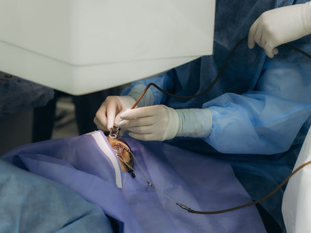 Cirugía de catarata después de LASIK: ¿por qué el cálculo del lente requiere mayor precisión?