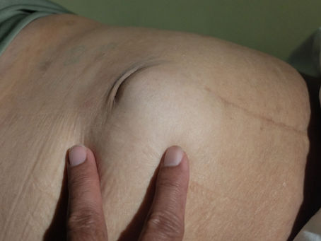 ¿Qué es una hernia estrangulada?