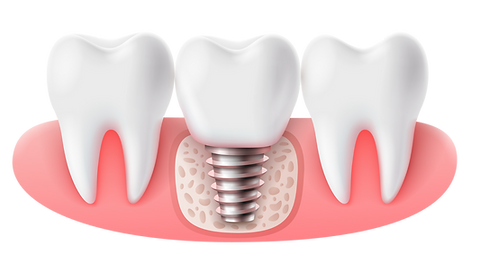 implante-dental2.png