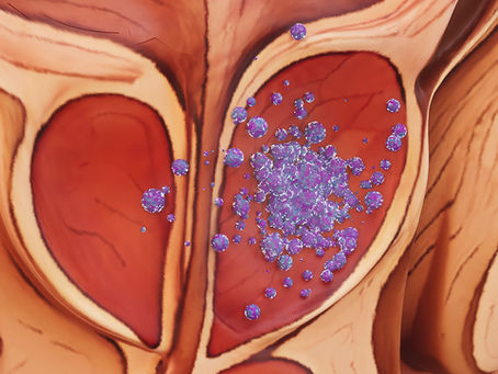 Cáncer de próstata: causas, síntomas, diagnóstico y tratamiento