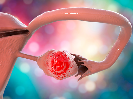 UNA REVISIÓN SOBRE CÁNCER DE OVARIO
