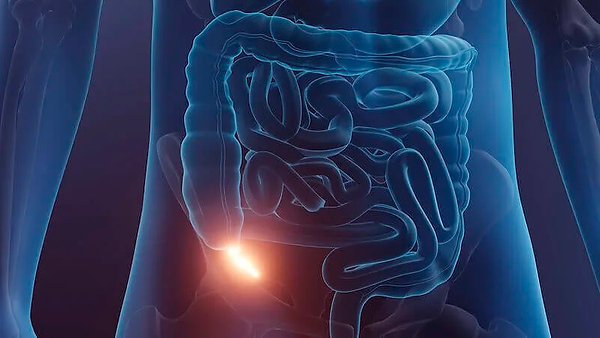 Apendicitis-imagen-grande.png