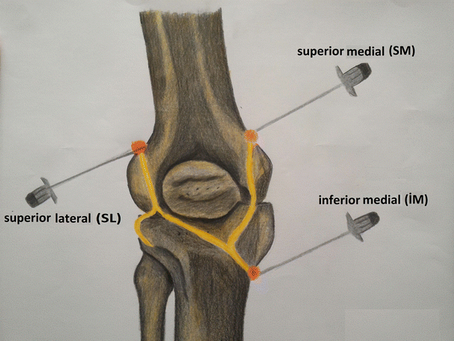 Neurolysis for chronic arthritic pain and tendinitis!