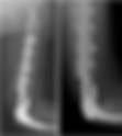 Implant loosening: Is bone allograft the solution?
